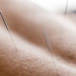 A young woman getting an acupuncture treatment on her back. she is lying face down on the bed.